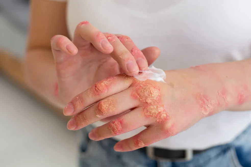 starostlivosť o pokožku pri psoriáze