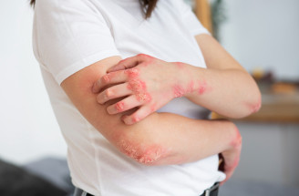 Psoriáza pod kontrolou: Všetko, čo potrebujete vedieť o lupienke!