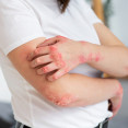 Psoriáza pod kontrolou: Všetko, čo potrebujete vedieť o lupienke!